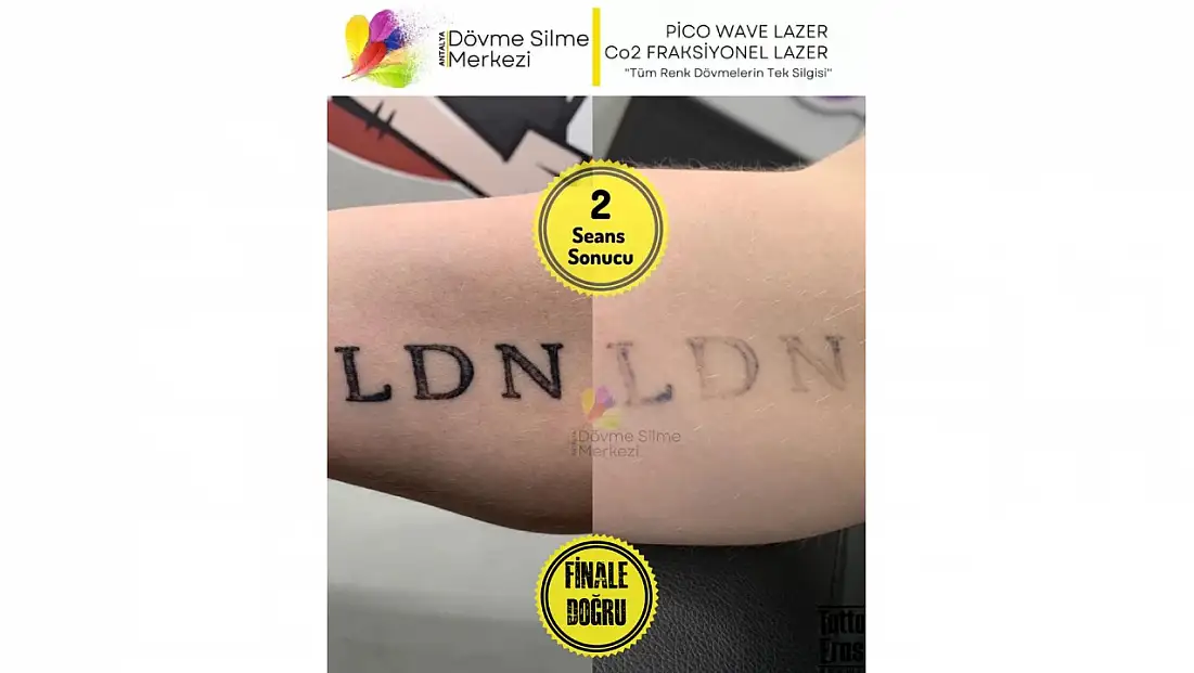Antalya Dövme Silme Merkezi Lara Şubesi İle Güvenli Bir Değişim Süreci Başlatın