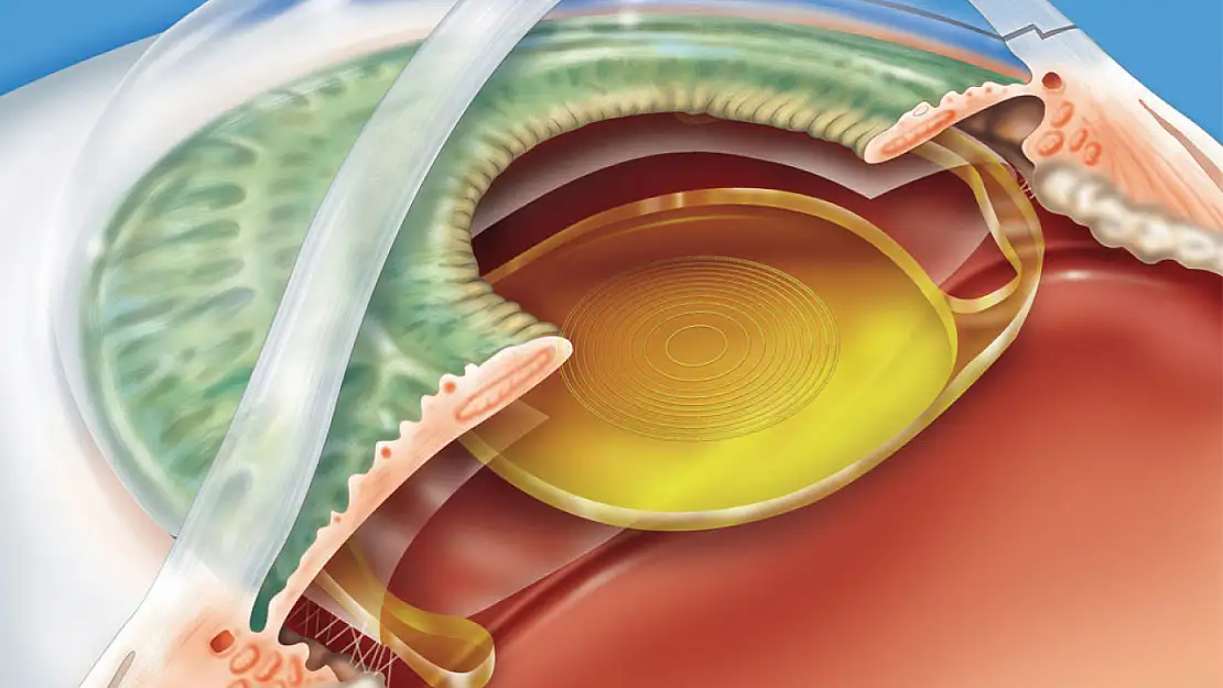 Görme Teknolojisinde Devrim: Göz İçi Akıllı Lensler