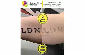 Antalya Dövme Silme Merkezi Lara Şubesi İle Güvenli Bir Değişim Süreci Başlatın