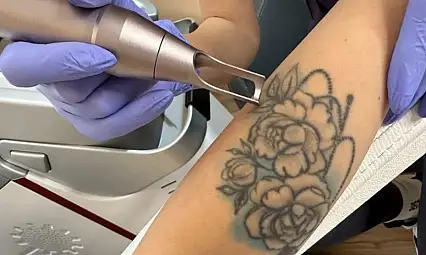 Antalya Dövme Sildirme Merkezi ile PİCO Wave Farkını Keşfedin