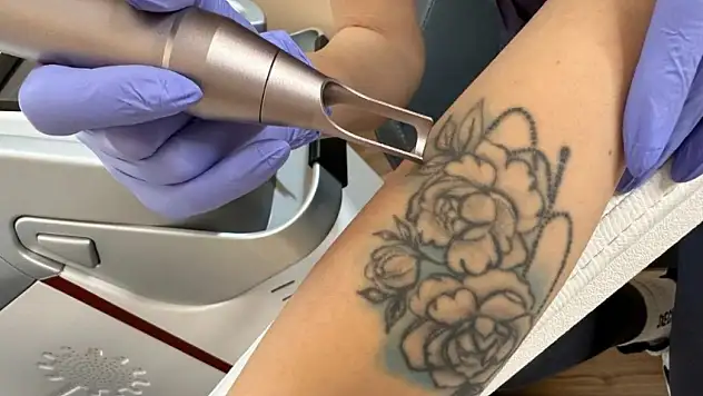 Antalya Dövme Sildirme Merkezi ile PİCO Wave Farkını Keşfedin