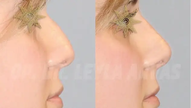 Burun Dolgusu İle Ameliyat Olmadan Burnu Şekillendirmek Artık Mümkün