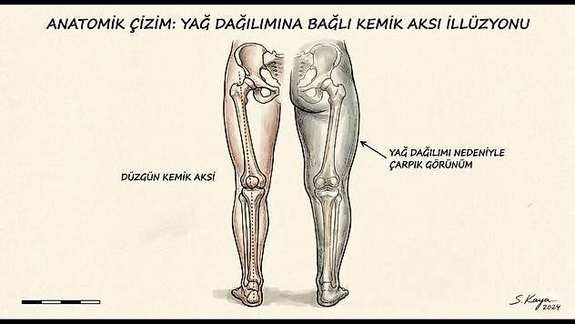 Çarpık Bacaklarda Ameliyatsız Çözüm: Kamuflaj Tekniği