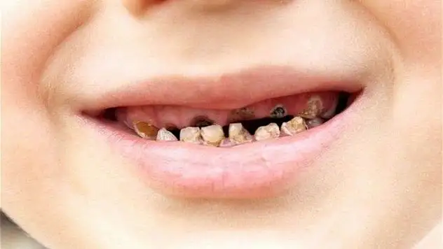 Diş Çürükleri Ölümcül Olabiliyor !