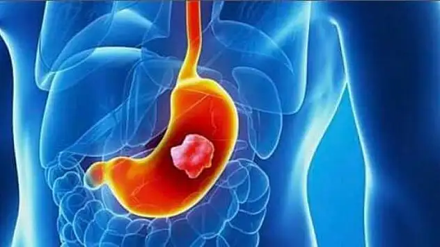 Mide Şikayetlerinde Bu İhtimal de Düşünülmeli…