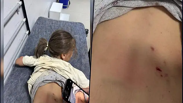 Mardin'de 7 yaşındaki Zeynep'e 3 sokak köpeği saldırdı