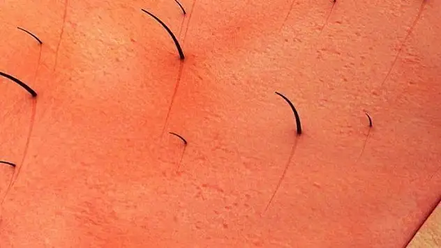 Tedavi Edilmeyen Kıl Dönmesi Birçok Sorun Oluşturuyor!