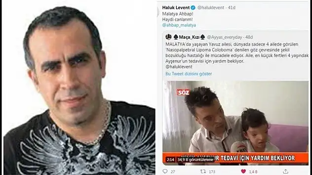 Türkiye'de  2 ailede görülen Nasopalpebral Lipoma Coloboma Sendromu çocuk için harekete geçti