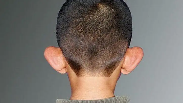 Kepçe Kulak Okul Çağındaki Çocukların Psikolojisini Etkiliyor !