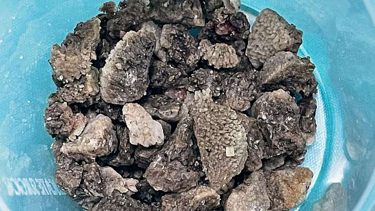 Malatya'da 8 Santimetrelik Böbrek Taşı Kapalı Yöntemle Çıkarıldı