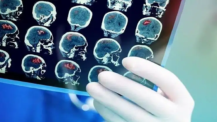 Serebral palsi nedir, belirtileri nelerdir?