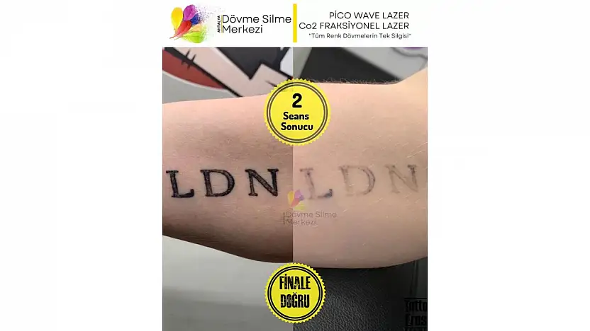 Antalya Dövme Silme Merkezi Lara Şubesi İle Güvenli Bir Değişim Süreci Başlatın