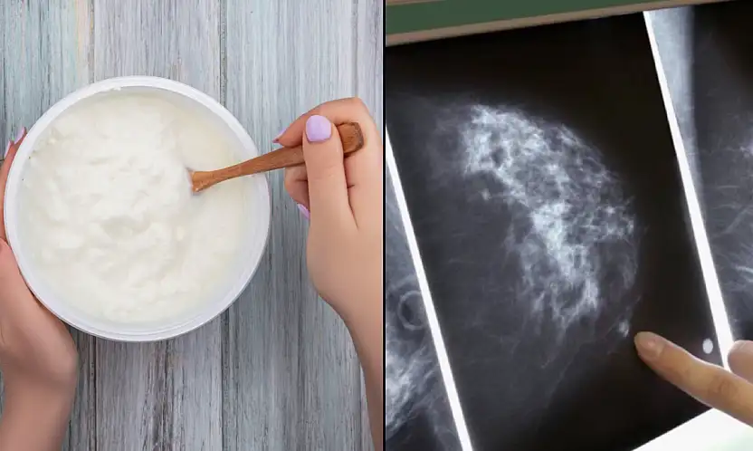 Araştırmacılardan meme kanserine ilişkin yeni hipotez: Zararlı bakteriler iltihaplanmayı tetikliyor olabilir