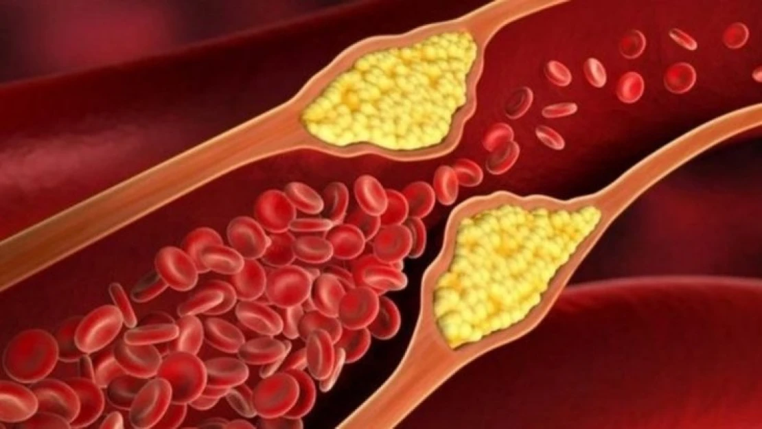 Yüksek Kolesterol Nedir? Kolesterol Hastaları Nelere Dikkat Etmeli?