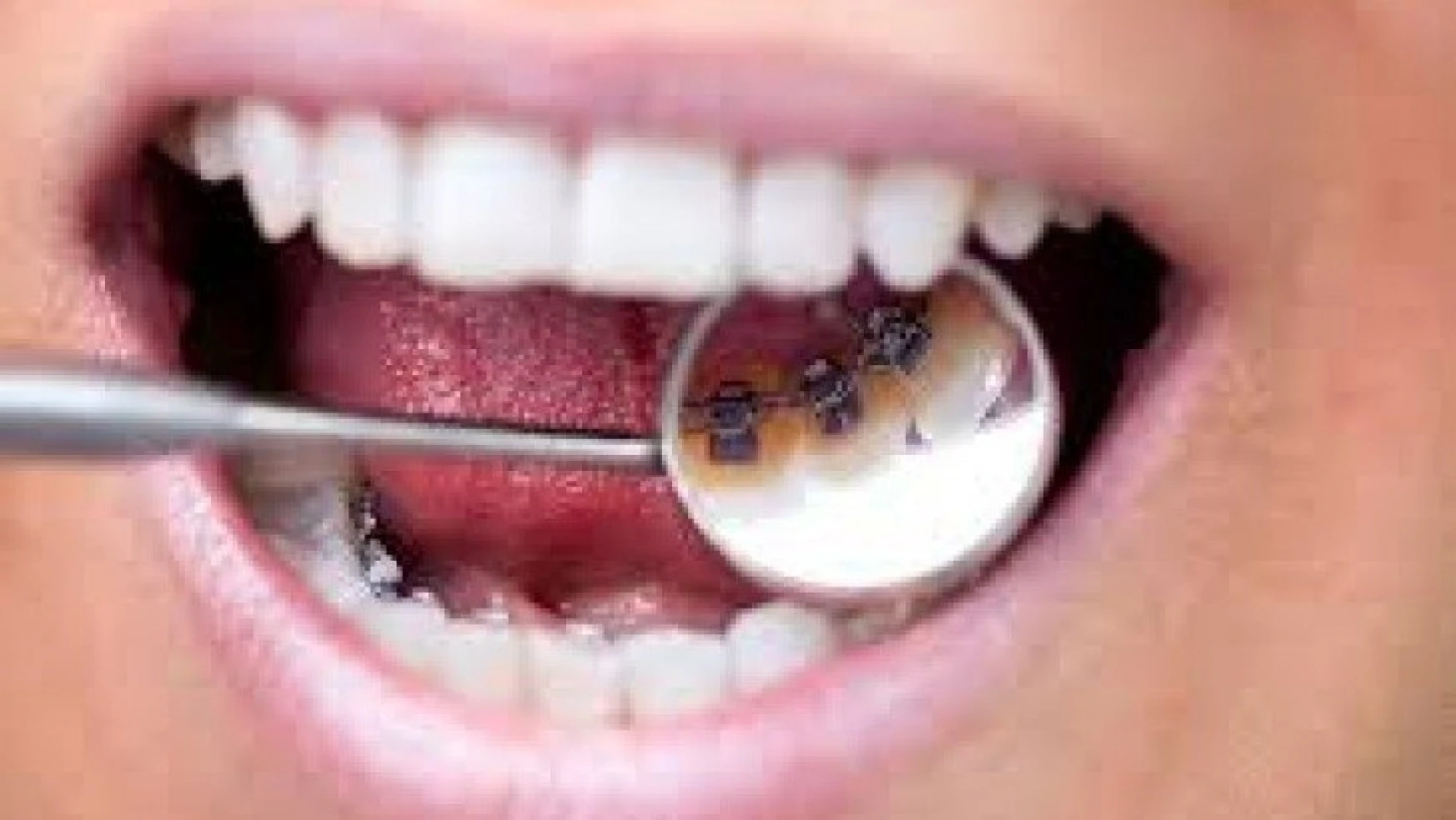Çapraşık Dişler Nasıl Tedavi Edilir ?