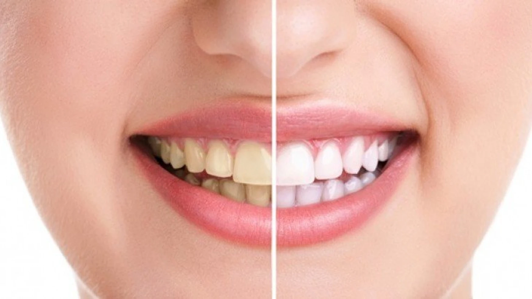 Daha Beyaz Dişlere Sahip Olabilirsiniz