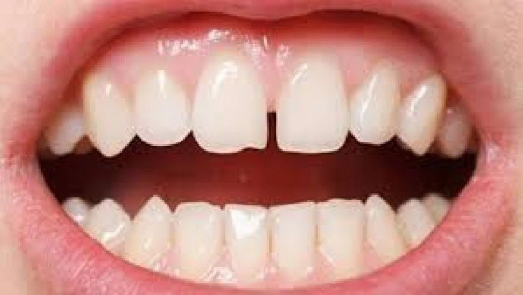 Diş Eti Enfeksiyonu Bağışıklık Sistemini Olumsuz Etkiliyor !