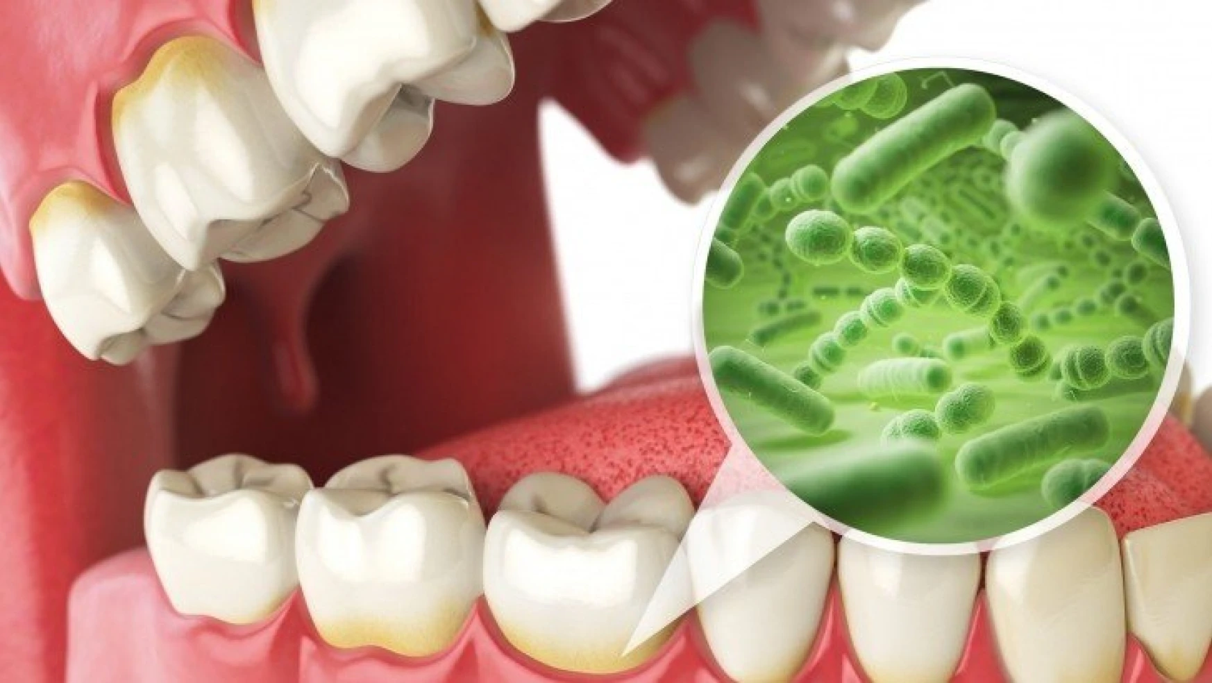 Diş Etindeki Bakteri Oluşumuna Dikkat !